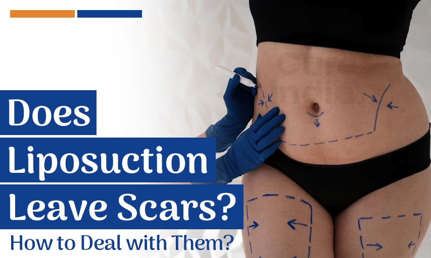 Does Liposuction 360 Leave Scars and How to Deal with Them?